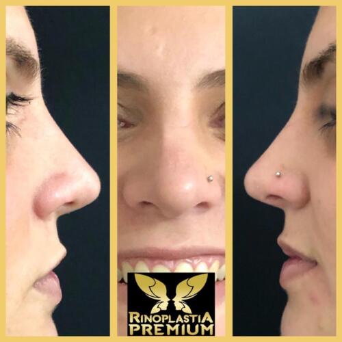 Rinoplastia Premium