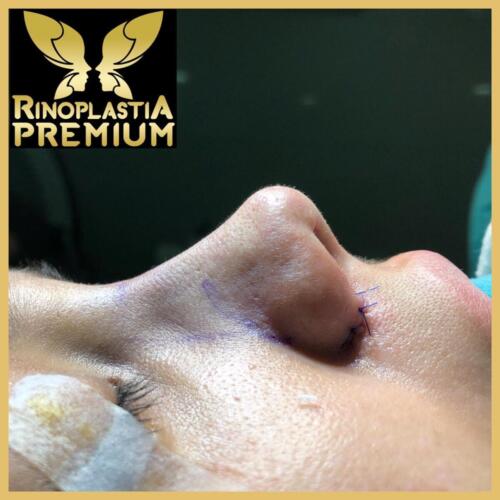 Rinoplastia Premium