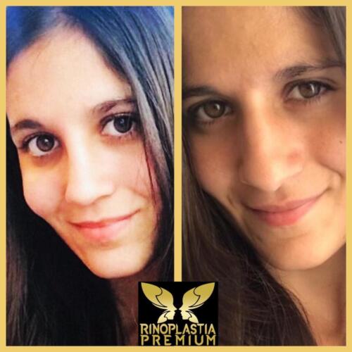 Rinoplastia Premium
