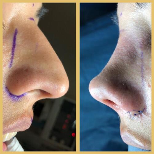 Rinoplastia Premium